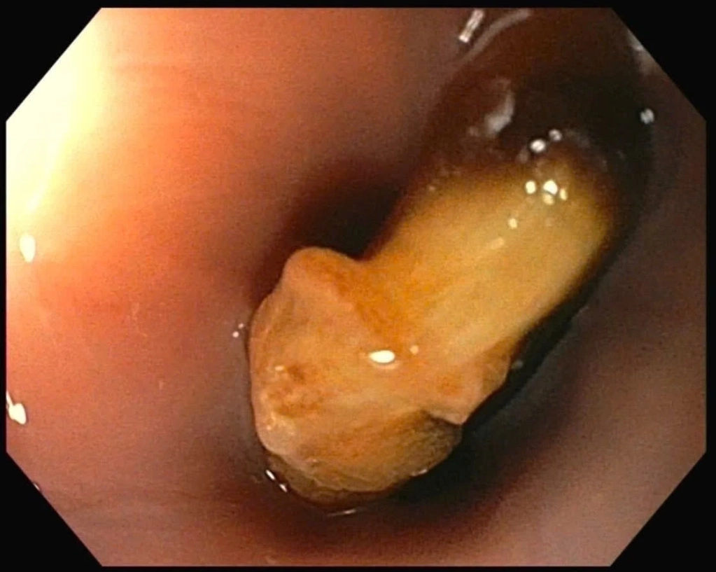Hóc hạt hồng xiêm - xử trí nhanh trong “thời gian vàng”