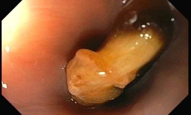 H&oacute;c hạt hồng xi&ecirc;m - xử tr&iacute; nhanh trong &ldquo;thời gian v&agrave;ng&rdquo;